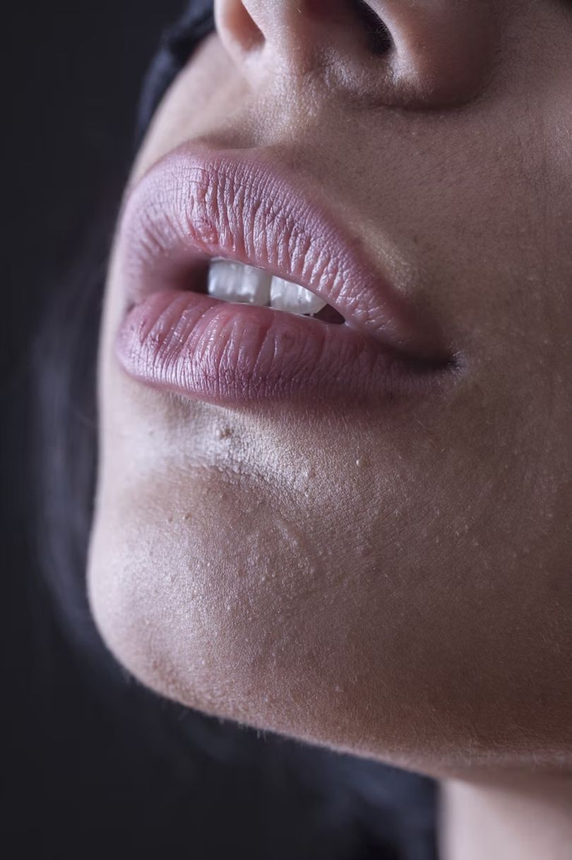 Understanding Lip Fillers